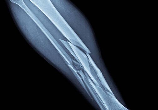 An x-ray of my shattered right leg showing multiple fractures of both the tibia and fibula.  This injury was the result of a skiing accident and oh man did it hurt.